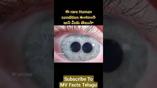 ఈ rare Human condition ఉంటుంది అని మీకు తెలుసా | Intersting Facts In Telugu | Amazing Facts Telugu