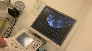 Ma premi&egrave;re &eacute;chographie apr&egrave;s le transfert