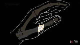 Thumb Extensor Tendon Laceration Repair