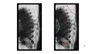 Proyeccion AP, lateral y oblicua de torax