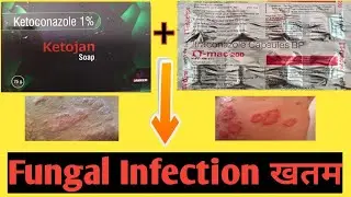 Keto Soap Uses,Benefits Side Effects | Ketoconazole (2% w/w) Soap🔥🔥 l By @Dr_Akshay