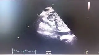 Hepatic mass during routine subcostal view