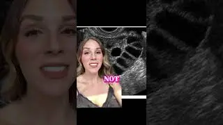 What are these?! If you have PCOS listen up! #pcos #shorts