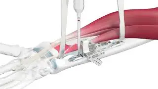 APTUS Wrist Ulna Shortening System 2.5 Surgical Technique