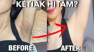 CARA MEMUTIHKAN KETIAK HITAM DENGAN ALAMI! 100% PASTI AMPUH!