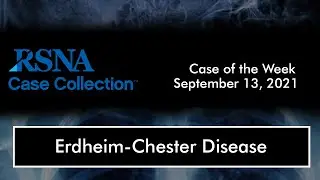Case of the Week: Erdheim-Chester Disease