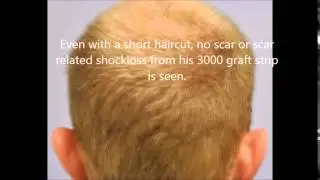 Understanding 6 months results by Dr. Lindsey Washington DC Hair Transplant Surgeon | McLean | VA