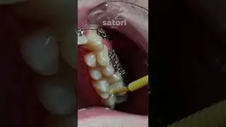 Окклюзионные накладки на зубы