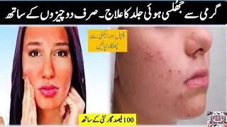 How to repair Skin burn | skin burn solution at home |NS Beauty Saloon