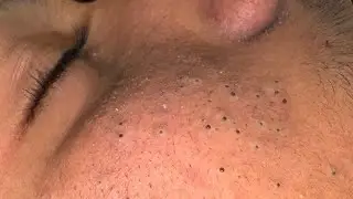 Soko Korean Skincare Routine (For Pimple Treatment & Deep Cleansing)