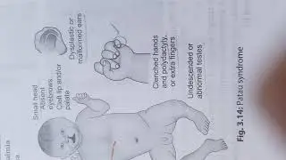 Cleft palate  photo