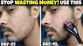 Derma Roller Beard Growth After 45 Days (Real Truth) | Derma Roller For Beard Growth 2026 | 