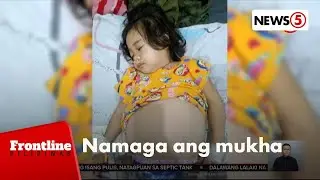 Babaeng paslit, namaga ang mukha at lumobo ang tiyan dahil sa sakit sa bato | Frontline Pilipinas