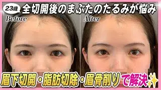 【23歳 目元整形】骨を削って、まぶたのたるみを無くす✨加工なしで盛れる顔に💡【眉下切開＋骨削り】