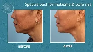 Spectra Peel for melasma and pore size San Diego Art of Ski