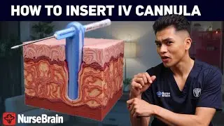 How to Insert an IV Cannula: Step-by-Step Guide