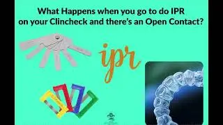 What Happens if you have an Open Contact on your Invisalign Case when you go to do IPR?