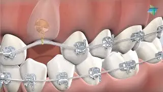 Expose & Bond in Foster City, CA | Foster City Oral Surgery Specialists