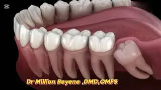 የመጨረሻው ጥርስ ፣መቼ መነቀል አለበት?/የሚነቀልበት ምክንያትስ