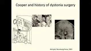 Нейрохирургия ЦНС 100: Нейрохирургия при дистониях