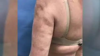 Must See Before and After Upper Arms Lipo Dr. Thomas Barnes Newport Beach Cosmetic Surgeon! Amazing!