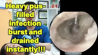 Heavy pus filled infection burst and drained insta | ear cleaning | ASMR earwax | soothing |relax|