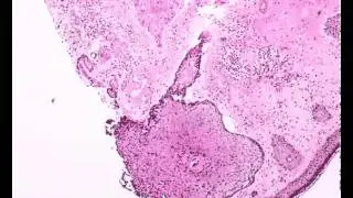 BCC on biopsy and wider excision