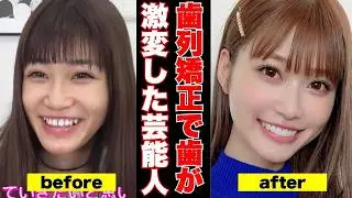 【衝撃変化】歯並び矯正した芸能人のビフォーアフター【ガルちゃん芸能】