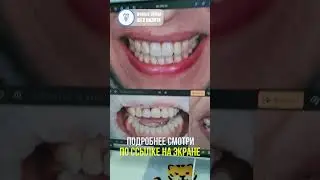Иллюстрация пути, который мы прошли с пациентом. Имплантация зубов #dentist
