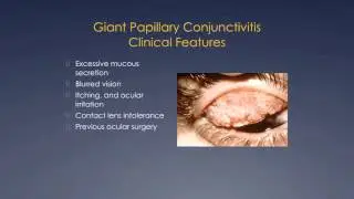 Ocular Allergy And Keratoconus by&nbsp;David Chu, MD