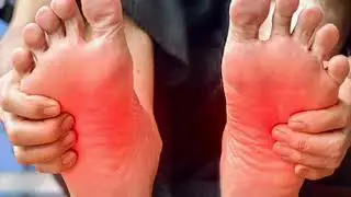 ERITROMELALGIA Dolor y ardor en los pies 👣 pies calientes DOLOR DE PIES