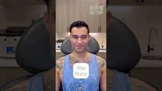 Male Botox Before & After | Prevent Wrinkles Early