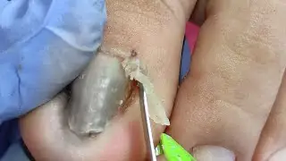 Ang tindi ng paa ni maam ang dami at ang laki pa ng mga dry skin grabi