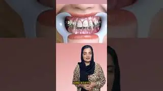 Clear Aligners or Braces?