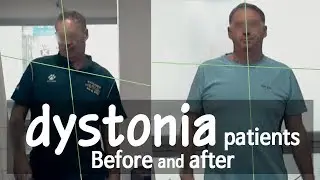 Treatment cases of dystonia patients/Before and after / 사경증 치료사례 전후 모음 /  / 근긴장이상증