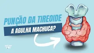 Como funciona a Punção Aspirativa da Tireoide? | 10 Minutos com o cirurgião #EP6