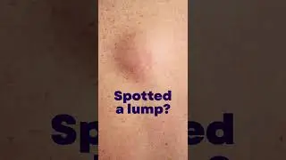 Spotted a lump? Check it, don't chance it. (short)