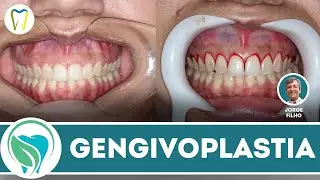 Gengivoplastias: muito além de cortar gengivas