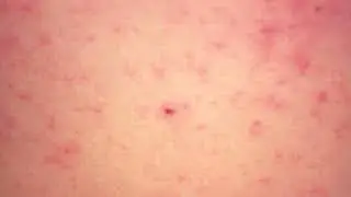 BC Centre for Disease Control confirming six new measles cases in Northern health