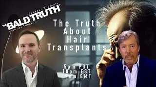Hair Transplants The Truth - The Bald Truth - June 21st, 2024