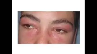 Dermatological manifestation of systemic diseases
