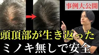 【副作用なし】ミノキシジルなしで髪の毛が生き返った事例を大公開