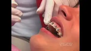 Advanced Orthodontics - Orthodontic Emergencies