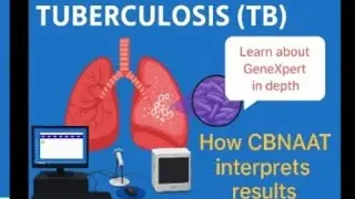 Interpretation of Results on CBNAAT/Genexpert for MTB Rif testing (Nucleic Acid Amplification test)