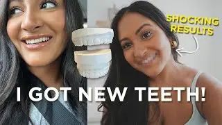 I GOT VENEERS! Pre-Op, Designing The Smile & Putting In The Temp Veneers | Dr.Tejas Patel Austin, TX