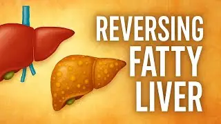 Reverse Fatty Liver Naturally:Top Tips, Diet & Exercise That Work| Fatty Liver treatments at home