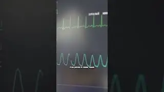 Understanding SVT Management #SVT #ECG #RhythmStrips #CardiacNursing #NCLEX #Shorts