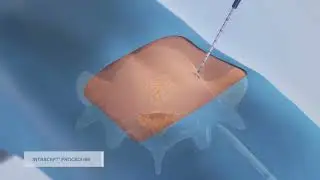 Intracept Procedure Performed at OrthoConnecticut