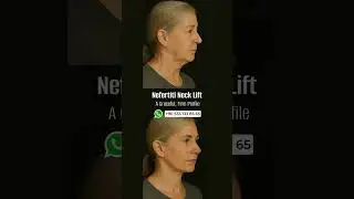 Nefertiti Neck Lift: A Regal Touch for a Smooth, Sculpted Neckline 👑
