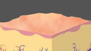 How PicoSure Focus (or PicoFocus) Works